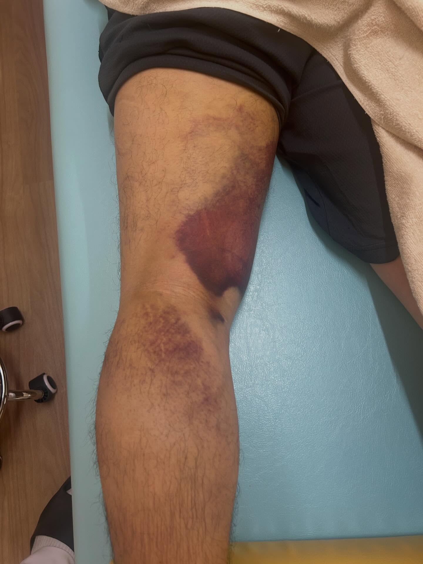 下関のみよし鍼灸整骨院内で撮影された肉離れのひどい内出血が出てる写真